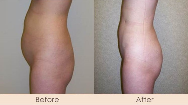 External Ultrasonic Liposuction of Abdomen