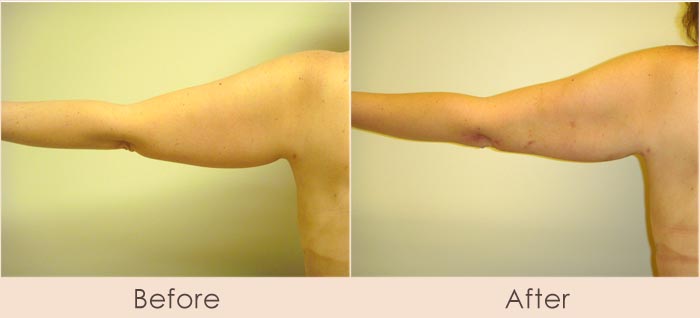 External Ultrasonic Liposuction of Arms