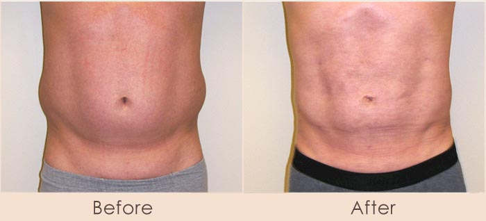 Male External Ultrasonic Liposuction of Abdomen and Waist