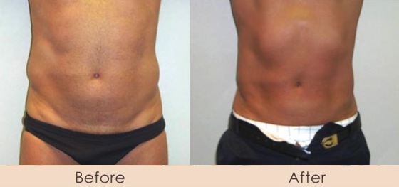 Male External Ultrasonic Liposuction of Abdomen and Waist