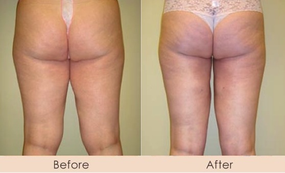 Liposuction of Inner Thighs with Smart Lipo MPX Inner Thighs