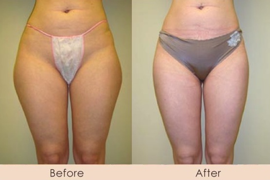 Liposuction of Inner and Outer Thighs
