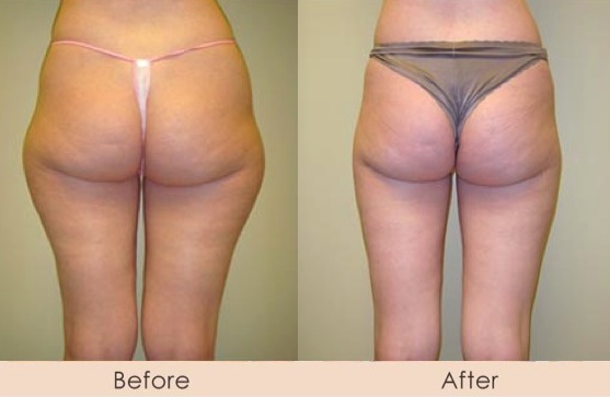 Liposuction of Inner and Outer Thighs