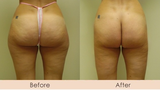 Liposuction of Outer Thighs and Buttocks