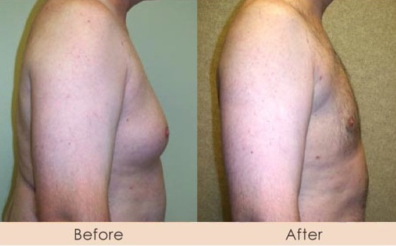 Male Liposuction of Chest