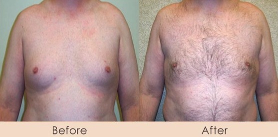 Male Liposuction of Chest