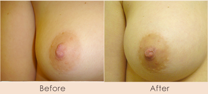 Nipple Reduction – Wedge