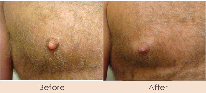 Male Nipple Reduction