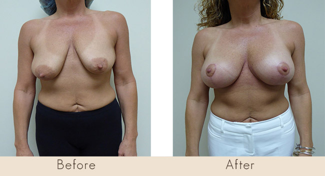 Mastopexy with Silicone Breast Implants under muscle Left implant 300cc Right implant 255cc