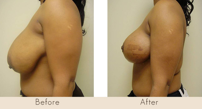 Mastopexy with Saline Breast Implants under muscle Left 300-340cc Right 300-310cc 