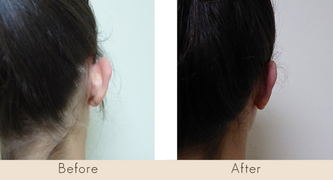 Ear Reconstruction - Otoplasty