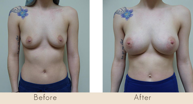 Silicone Breast Augmentation Under Muscle Inframammary Incision 300cc