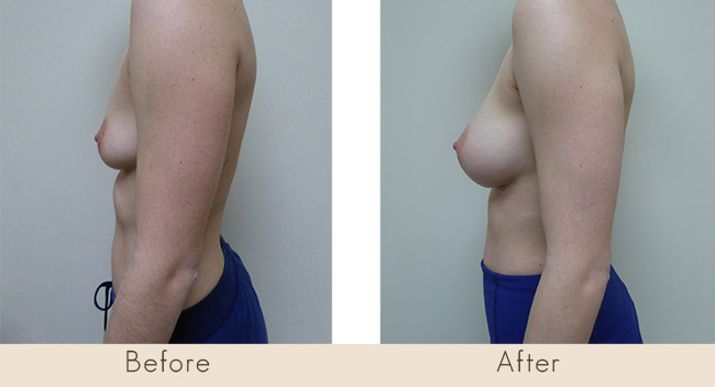 Silicone Breast Augmentation Under Muscle Inframammary Incision 300cc