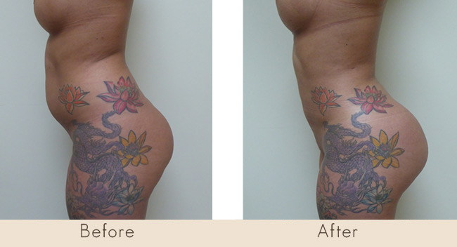 Lipo of Abdomen and Waist / Fat Transfer to Buttocks 6 Weeks Post Surgery