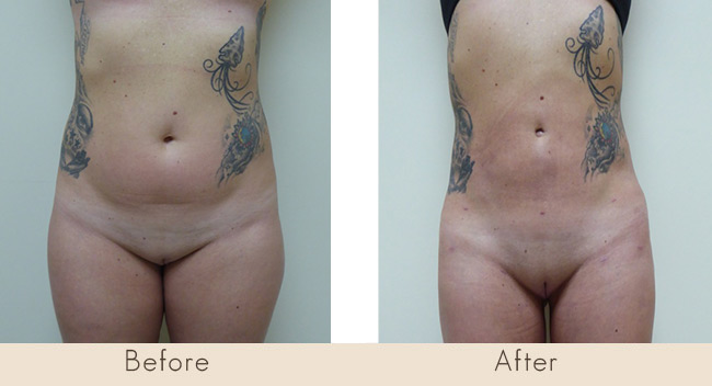 Liposuction of Thighs / Full Abdomen and Waist 7 Weeks Post Surgery