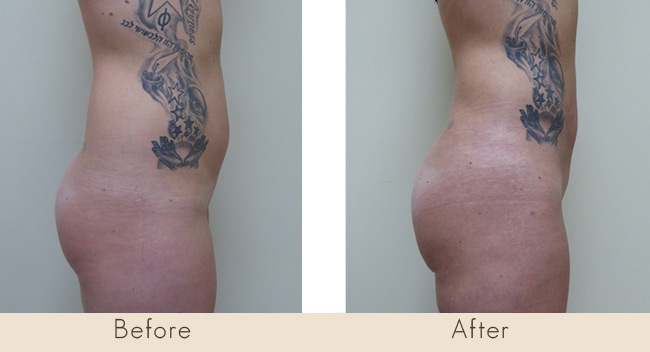 Liposuction of Thighs / Full Abdomen and Waist 7 Weeks Post Surgery