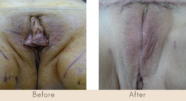 Vaginal Labiaplasty 6 weeks post surgery