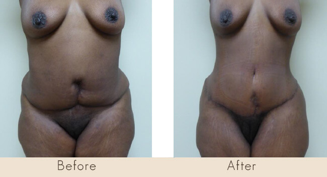 Revision Tummy Tuck 8 Weeks Post Surgery