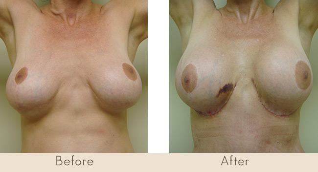 This patient had a breast augmentation and breast lift by another surgeon. She is bottoming out deformity bilaterally with a mound on a mound or Double Bubble deformity as a result. She has high nipple and areola as well. She underwent a repair by Dr. Gray re-supporting her implants and performing a horizontal mastopexy. She is 14 days post-op in this photo.