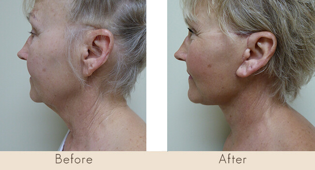 6 weeks post surgery Facelift with Liposuctin to Neck, and right side only Upper Lid Bleph with Lateral Fat Only