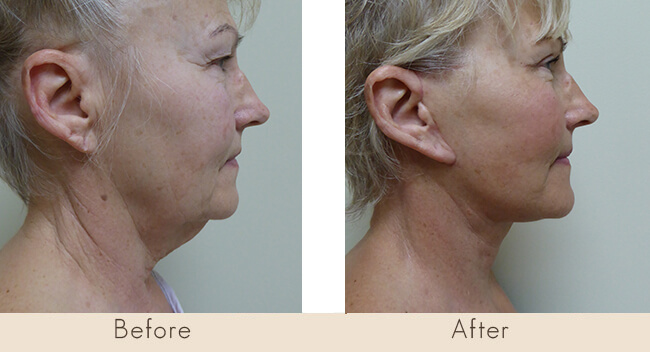 6 weeks post surgery Facelift with Liposuctin to Neck, and right side only Upper Lid Bleph with Lateral Fat Only