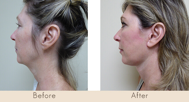 Facelift with Liposuction to neck and Transconjbleph with CO2 Laser Lower lids with Upper Lid Bleph