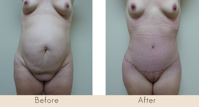 Hour Glass Tummy Tuck 6 Weeks Post Surgery