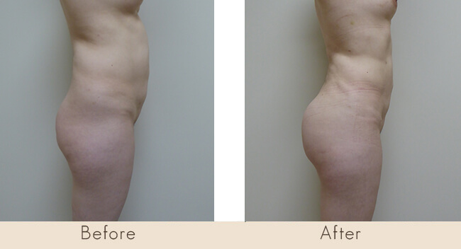 Liposuction of Waist and Hip / Fat Transfer to Buttock