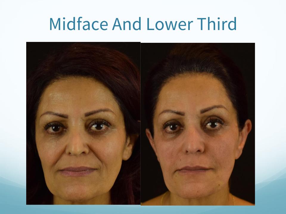 Midface & Lower Third