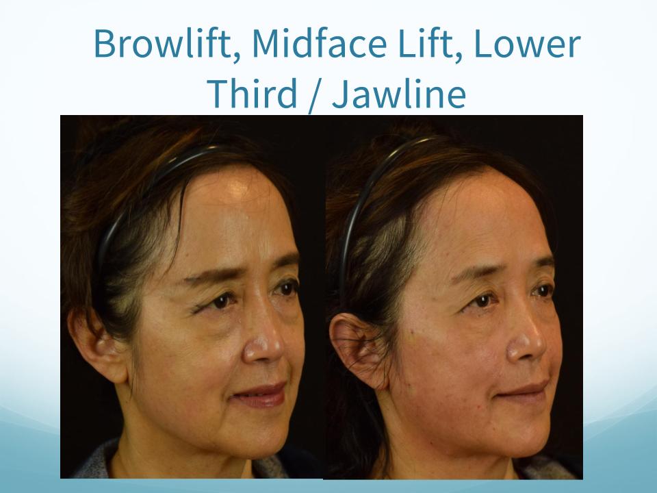 Browlift, Midface Lift, Lower Third / Jawline