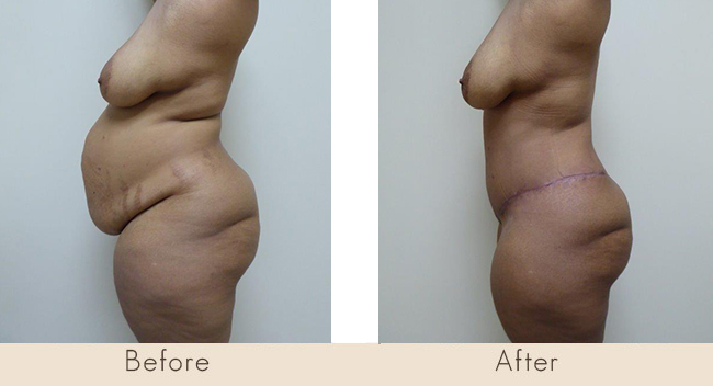 Hour Glass Tummy Tuck 6 weeks post surgery