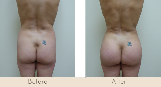 Liposuction to Full Abdomen, Back, Waist/Hip, Mons Pubis & Fat Transfer to Buttocks