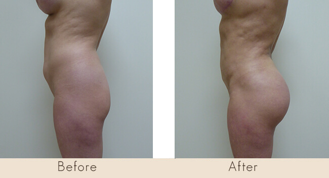 Liposuction to Full Abdomen, Back, Waist/Hip, Mons Pubis & Fat Transfer to Buttocks