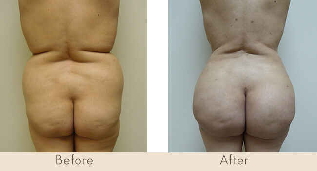 Liposuction to Back, Waist and Full Abdomen with Fat Transfer to Buttocks