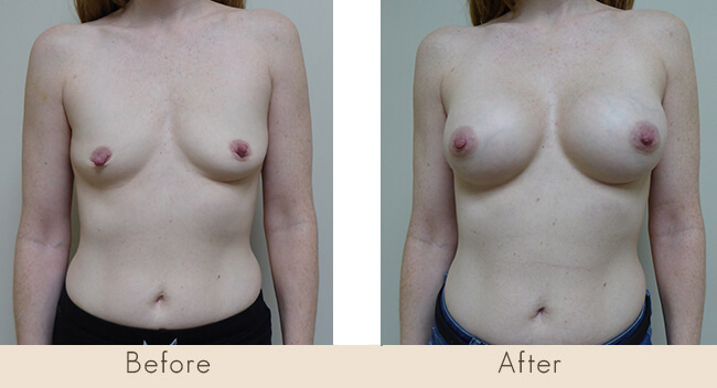 Endobam Left Implant 200-225cc Right Implant 200-240cc Moderate Profile Under Muscle with Bilateral Nipple Reduction