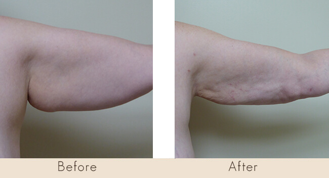 6 Weeks Post Surgery - External Ultrasonic Liposuction with Smart Laser Liposuction to Back of the Arms