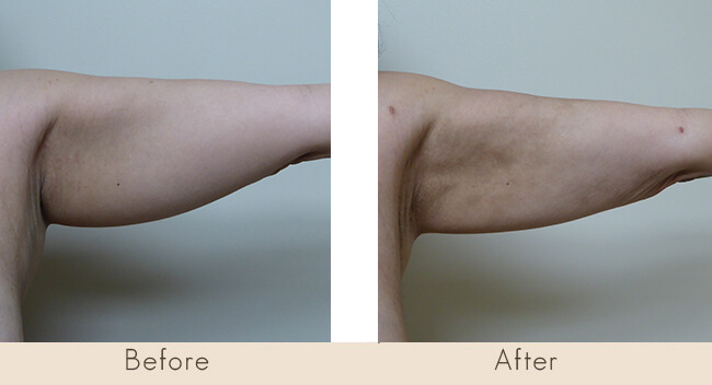 6 Week Post Surgery - External Ultrasonic Liposuction to Back of the Arms