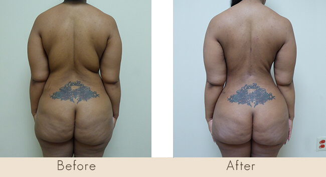 8 Weeks Post Surgery - External Ultrasonic Liposuction to Back