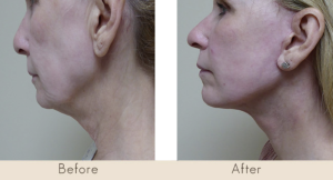 High Definition Facelift - Patient of Dr. Michael Gray