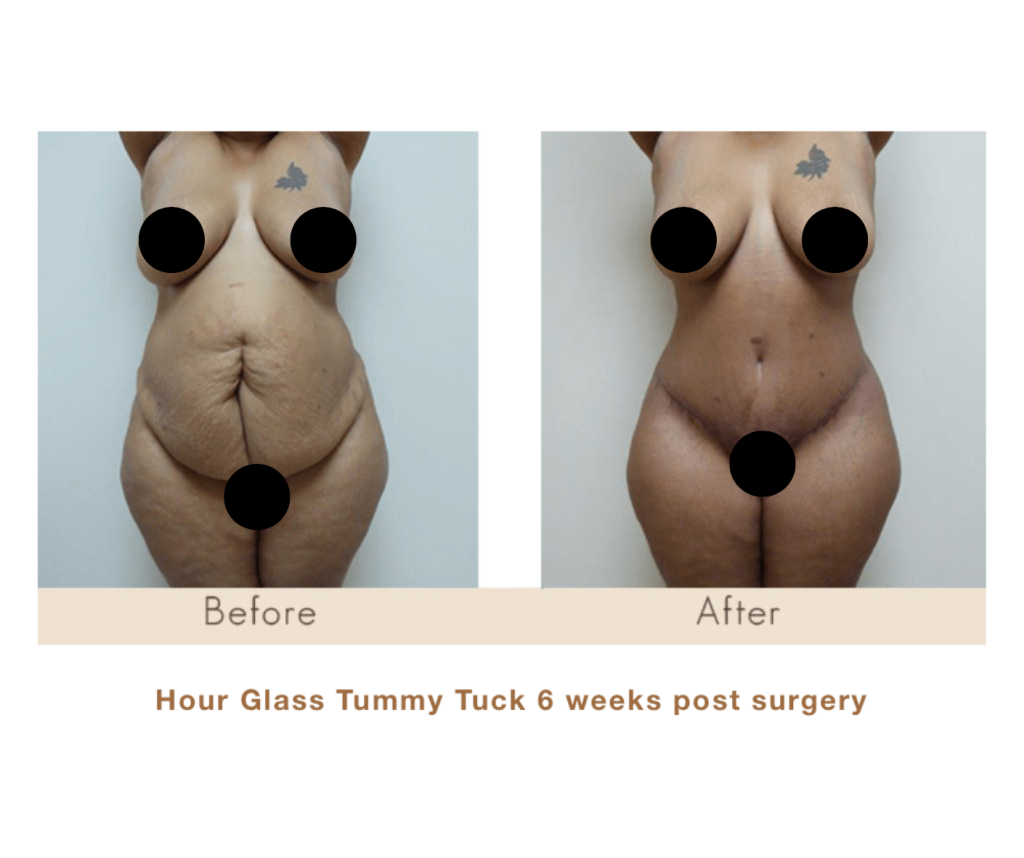 Hourglass Tummy Tuck by Dr. Michael Gray - Michigan Cosmetic Surgery Center and Skin Deep Spa