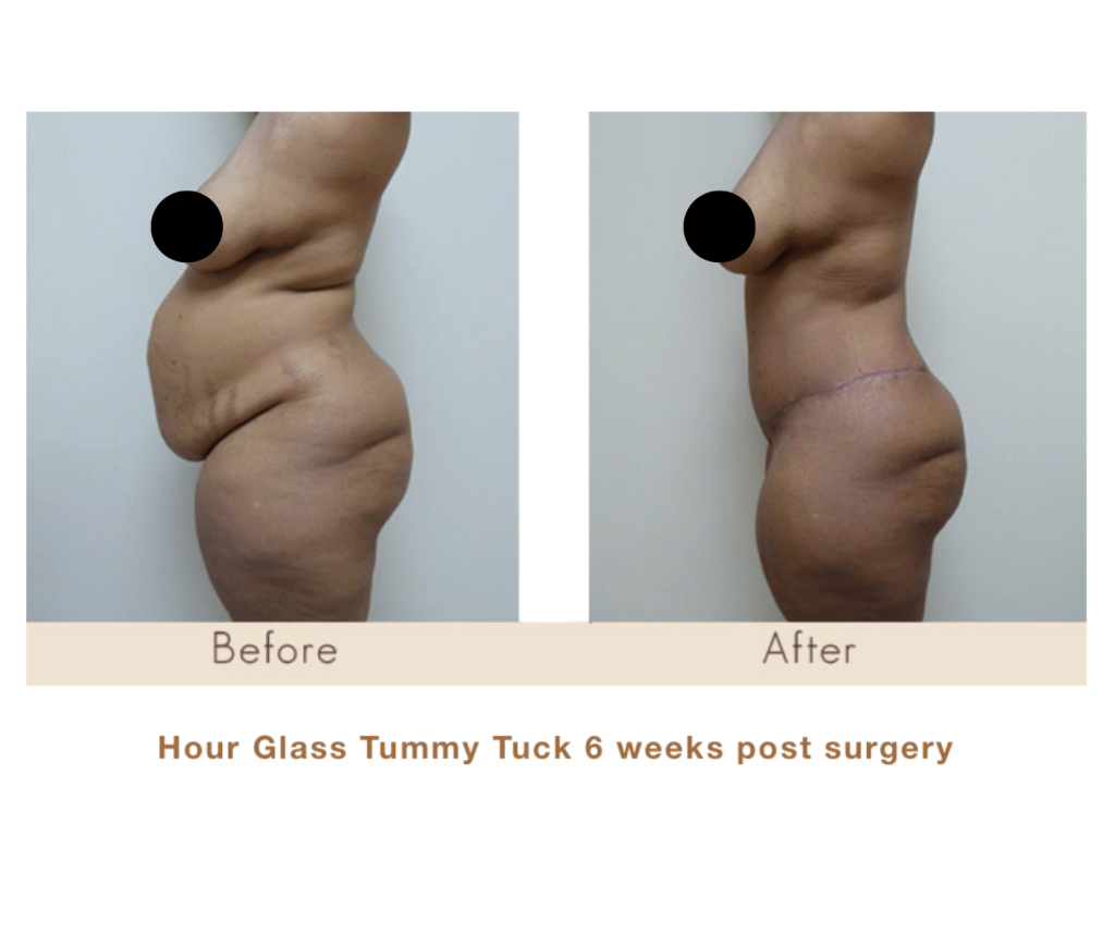 Hourglass Tummy Tuck by Dr. Michael Gray - Michigan Cosmetic Surgery Center and Skin Deep Spa