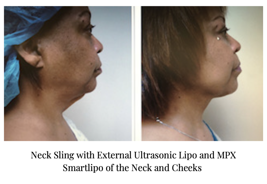 High Definition Facelift by Dr. Michael Gray. Neck Sling with External Ultrasonic Lipo and MPX Smartlipo of the Neck and Cheeks