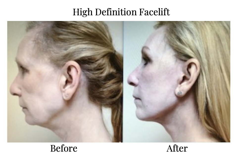 High Definition Facelift - Dr. Michael Gray