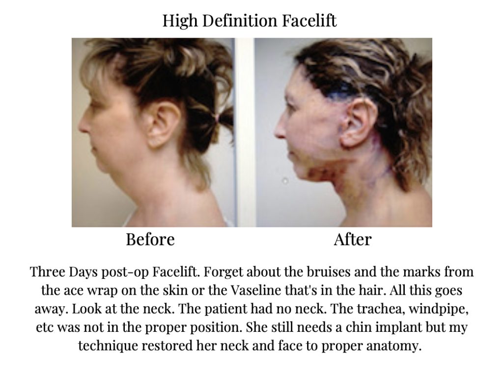 High Definition Facelift - Dr. Michael Gray