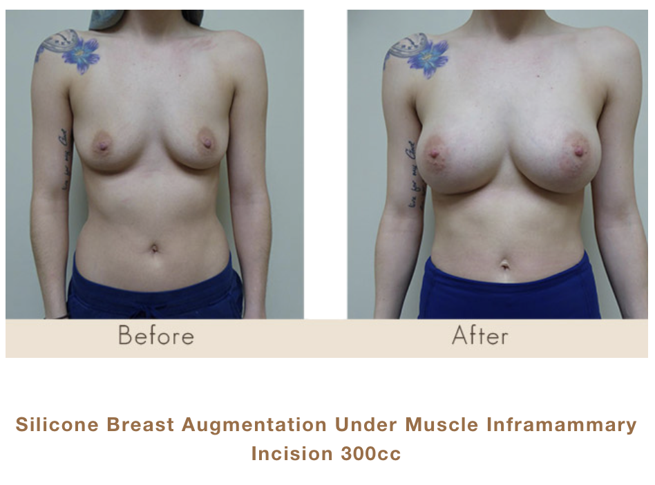 Silicone Breast Augmentation under Muscle Inframammary Incision 300cc