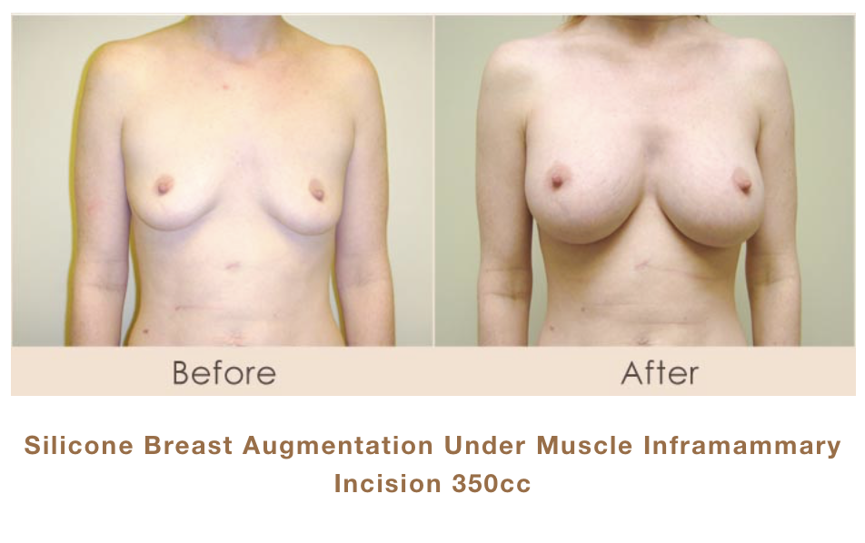 Silicone Breast Augmentation under Muscle Inframammary Incision 350cc