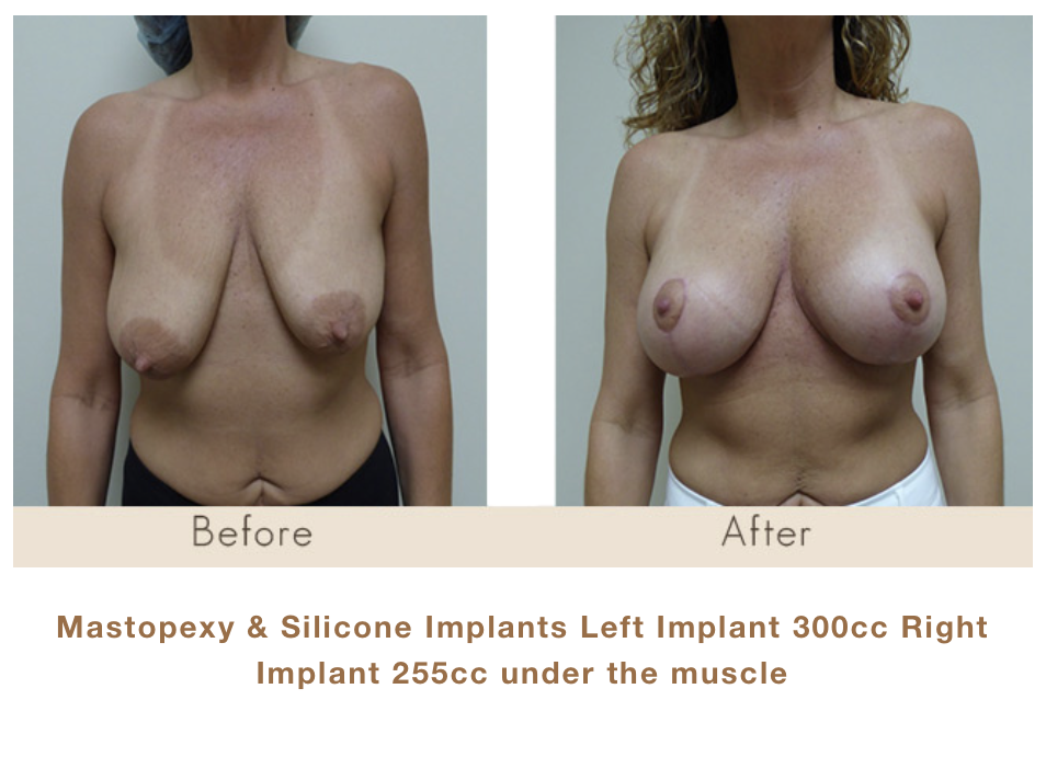 Mastopexy & Silicone Implants: Left Implant 300cc, Right Implant 255 cc Under The Muscle