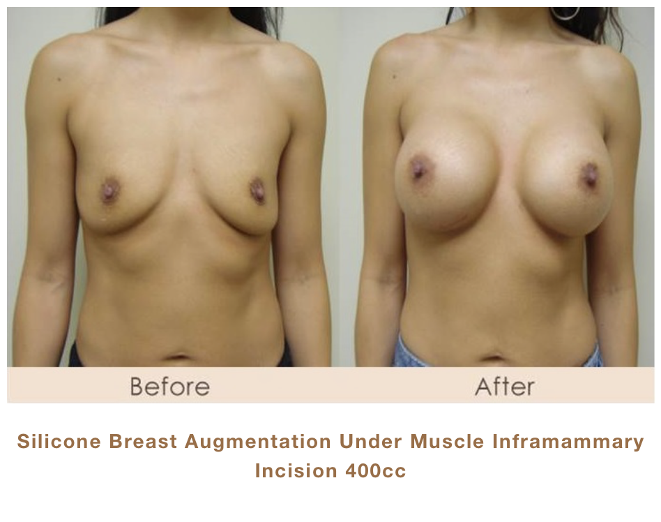 Silicone Breast Augmentation Under Muscle Inframammary Incision 400cc