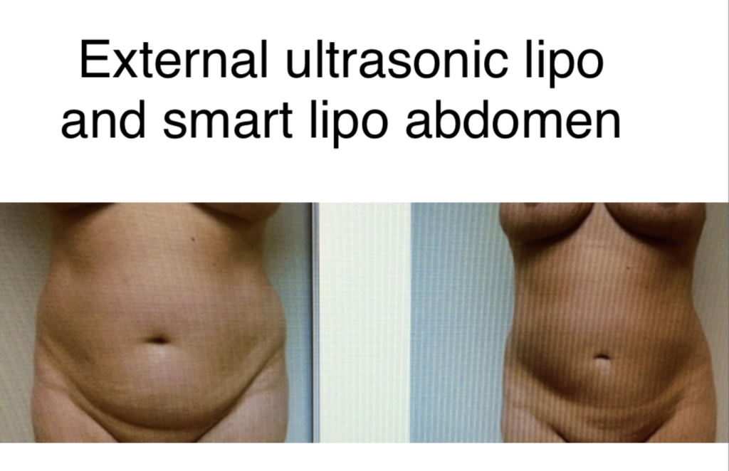 External Ultrasonic Lipo and Smartlipo Abdomen