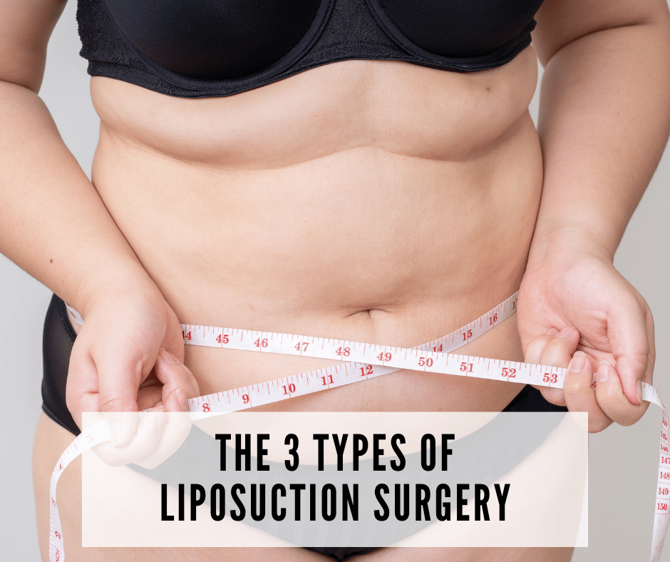 The 3 Types of Liposuction Surgery